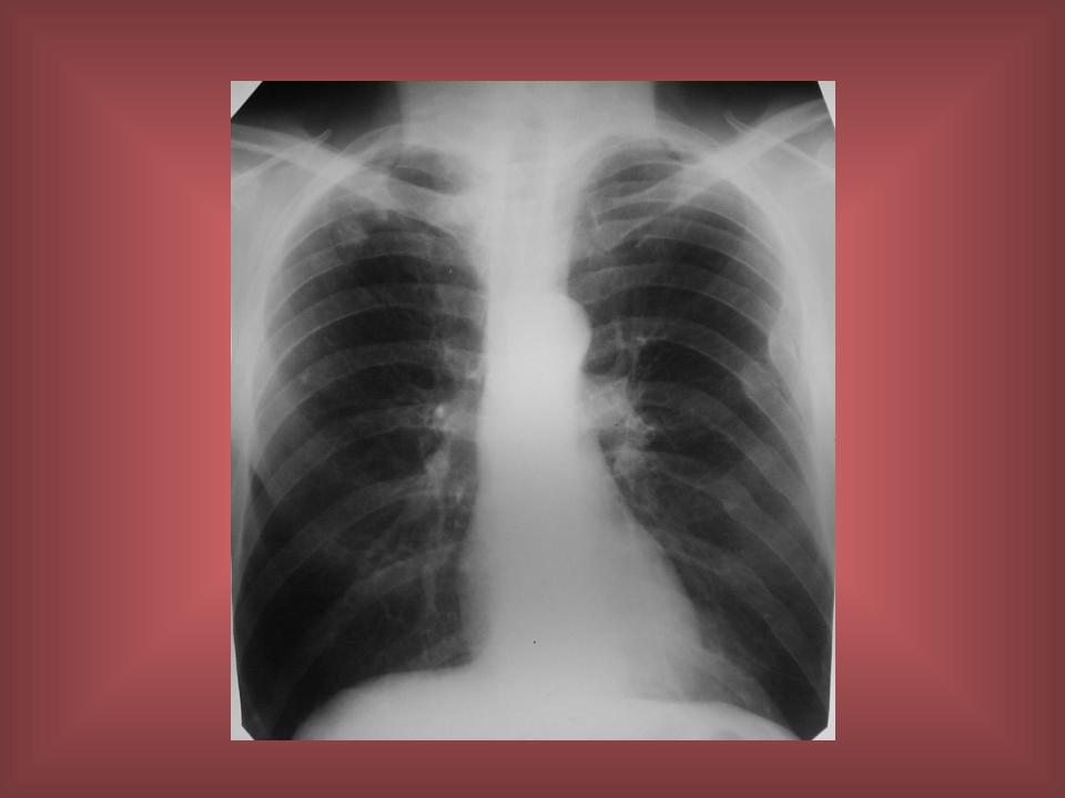 Тени в верхней доле легкого. Туберкулома верхней доли правого лёгкого. Туберкулома легких на кт. Туберкулома рентген.