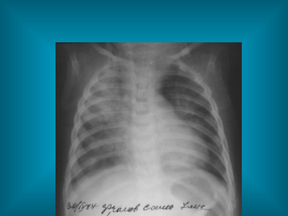Диагноз 34 лет. Рентгенограмма органов грудной полости. Г 34 диагноз. Септическая пневмония рентгенограмма.