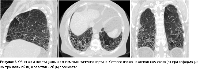 Лечение интерстициальной болезни лёгких в Израиле