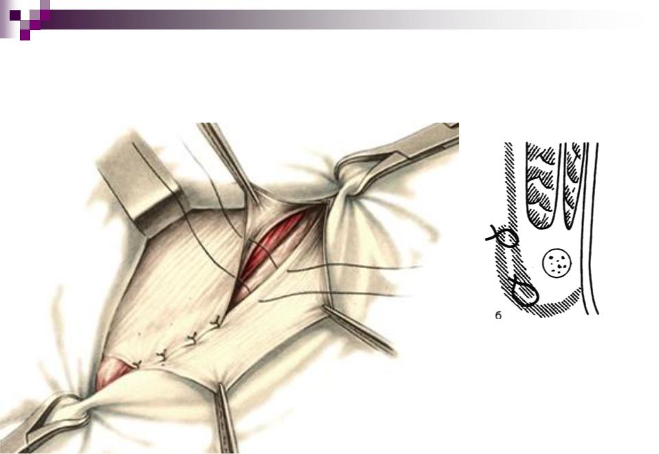 Схема пластики пахового канала