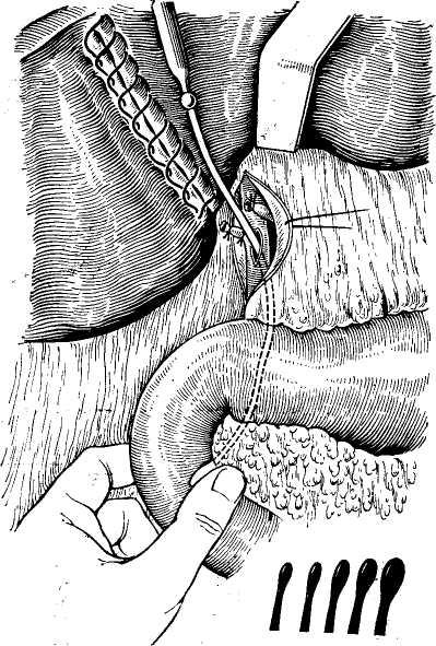 Зондирование желчного. Зондирование желчных протоков. Дренирование двенадцатиперстной кишки. Дренирование инфильтрата. Печёночный проток зондирование.