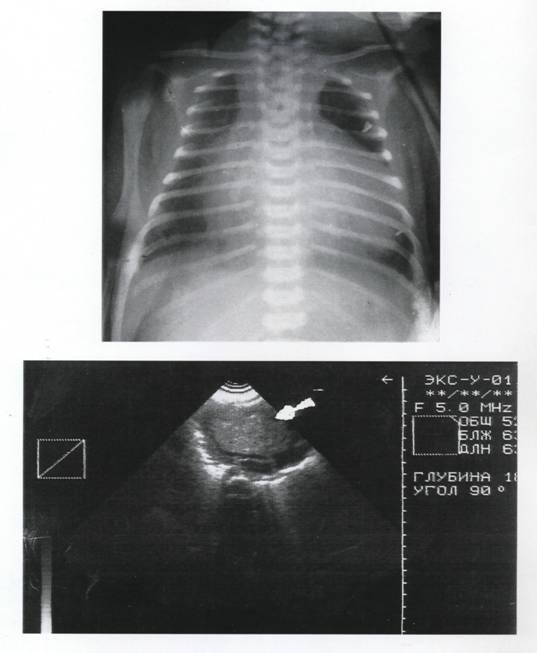 Рабдомиома сердца. Рабдомиома сердца левый желудочек. Рабдомиомы сердца у новорожденных. Опухоль сердца рентген.