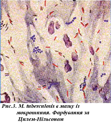 Палочки в мокроте. Микобактерии туберкулеза микроскопия. Микроскопия по Цилю Нильсену туберкулез. Микобактерия туберкулеза по Цилю Нильсену. Микобактерии туберкулеза под микроскопом по Цилю Нильсену.