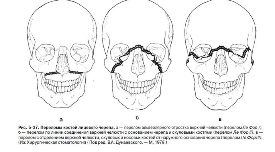 Перелом лицевого черепа. Контрфорсы черепа верхней челюсти. Перелом скуловой кости классификация. Скуловая кость перелом классификация. Перелом лицевой кости черепа.