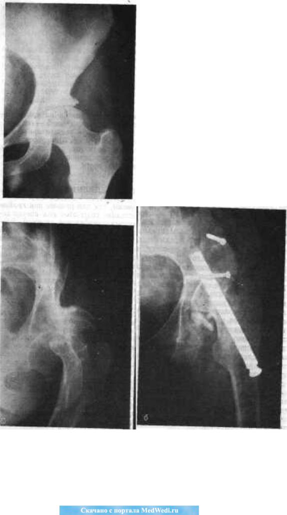 Патология тазобедренного сустава. Межвертельный перелом бедренной кости. Изолированные переломы Вертелов бедренной кости. Чрезвертельный перелом тазобедренного сустава рентген. Перелом малого вертела бедренной кости на рентгене.