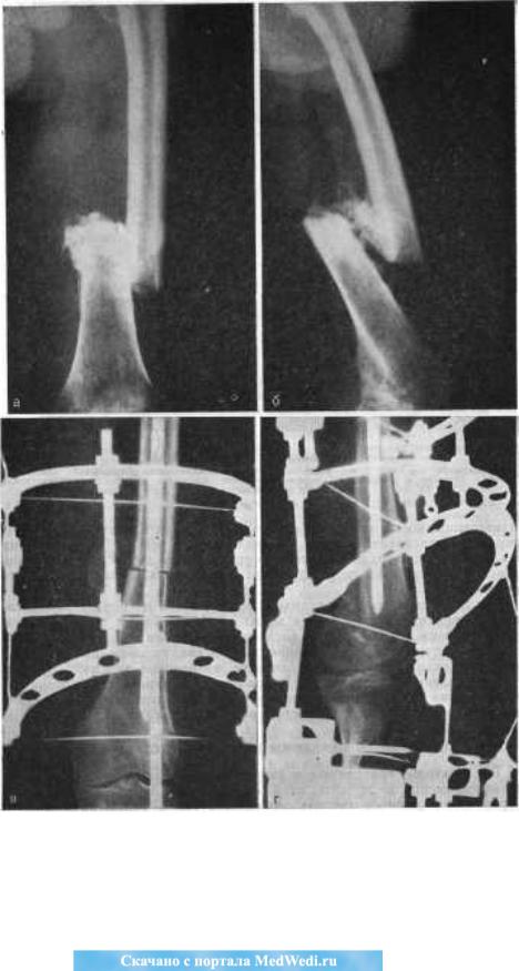 Сколько срастается трещина. Оскольчатый перелом диафиза бедренной кости. Остеосинтез внутрикостный (1 / 2 категория). Ложный сустав диафиза бедра. Оскольчатый перелом рентген.