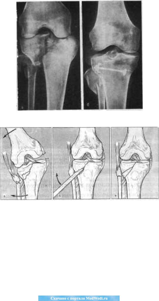 Мыщелок ноги. Перелом медиального мыщелка большеберцовой кости рентген. Перелом медиального мыщелка бедренной кости. Внутрисуставной импрессионный перелом большеберцовой кости.