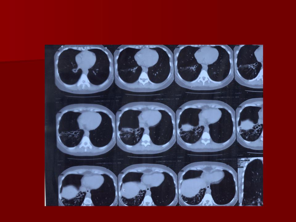 Кт д т. Мукормикоз компьютерная томография. Риноцеребральный мукормикоз компьютерная томография. Кт при гангрене легкого.