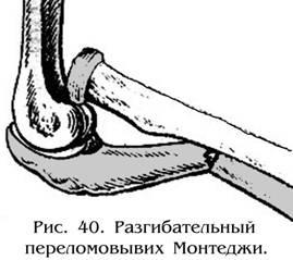 Типы переломов предплечья