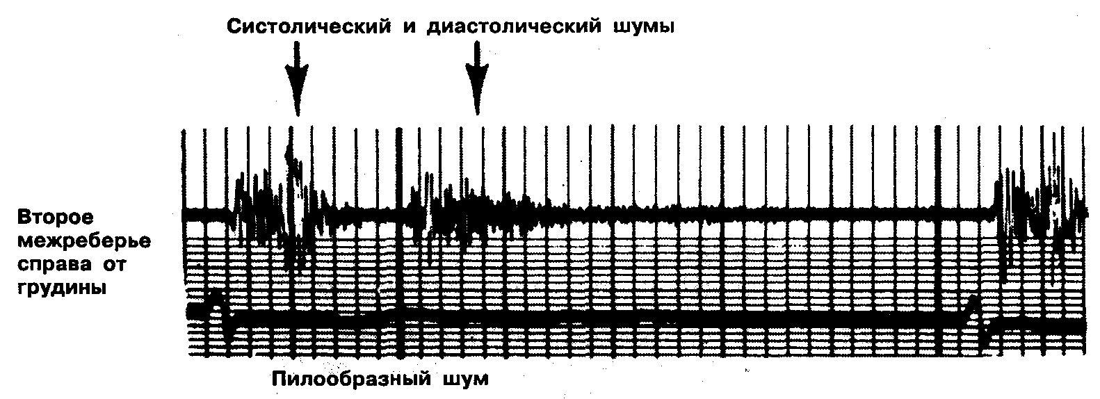 Систолический и диастолический шумы сердца. Систолический шум во втором межреберье справа от грудины. Систолический и диастолические шумы на изображении. Диастолические шумы сердца. Систолический шум это