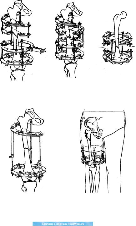 Аппарат илизарова купить