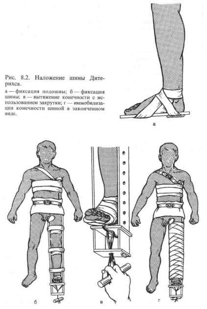 Повязки, иммобилизация, транспортировка пострадавшего | Мед. справочник туриста