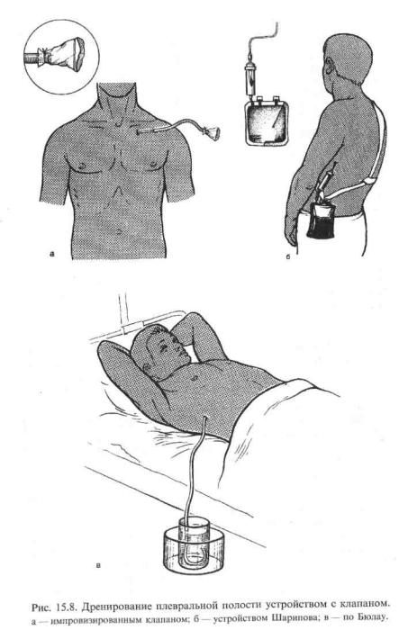 Дренирование плевральной полости. Плевральный дренаж при пневмотораксе. Дренаж легкого при пневмотораксе. Постановка дренажа по Бюлау. Пассивное дренирование по Бюлау.
