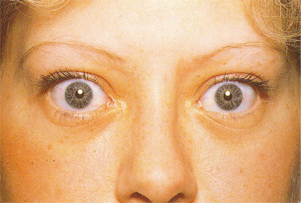 Признаки больных глаз. Тиреотоксикоз (базедова болезнь). Экзофтальм щитовидной железы. Тиреотоксикоз офтальмопатия. Базедова болезнь экзофтальм.