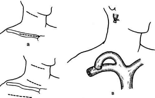Ухо после шунтирования. Тромбоз подключичной вены (синдром Педжета-Шретера).. Сонно подключичное шунтирование схема операции. Тромбэктомия подключичной вены. Тромбоз подключичной артерии.
