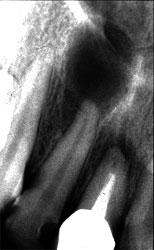 Периапикальная киста зуба лечение thumbnail