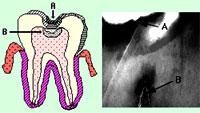 Периапикальная киста зуба лечение