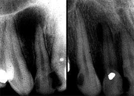 Периапикальная киста зуба лечение