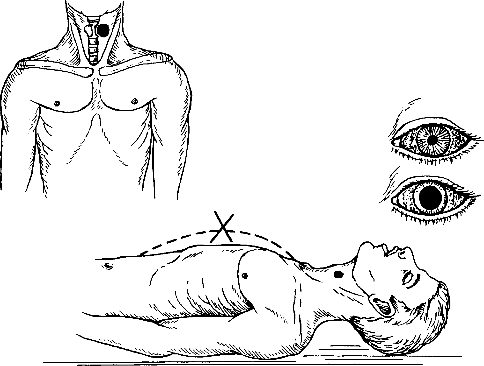 Рефлекторная остановка дыхания. Остановка сердца клиническая смерть. Симптомы остановки сердца. Остановка сердца и дыхания. Рефлекторная остановка сердца.