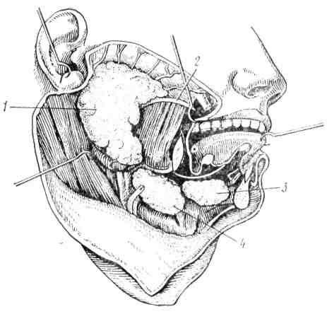 Ротовая полость физиология. Слюнные железы нижняя челюсть. Проток околоушной железы. Подчелюстная слюнная железа собаки. Подчелюстная слюнная железа человека.