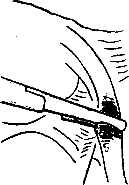 Вазэктомия или перевязка труб что выбрать. Перевязка трубных каналов в печах. Пряжкой перевязать трубу.