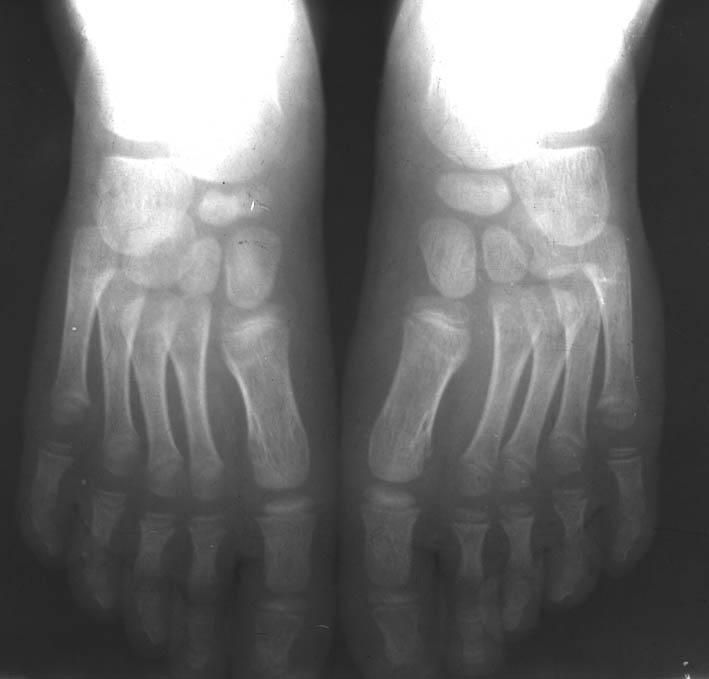 Болезнь келлера что это такое. Остеохондропатия 2 плюсневой кости. Остеохондропатия ладьевидной кости Келлер 1. Остеохондропатия ладьевидной кости стопы рентген.