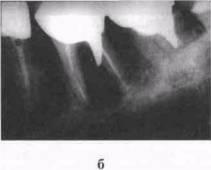 Осложнения при эндодонтическом лечении зубов