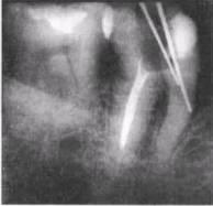 Осложнения эндодонтического лечения. Перфорация шейки зуба рентген. Перфорация корня зуба на рентгене. Перфорация корневого канала рентген. Перфорация корня гуттаперча.
