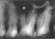 Ошибки и осложнения при эндодонтическом лечении зубов