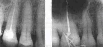 Ошибки и осложнения при эндодонтическом лечении временных зубов thumbnail
