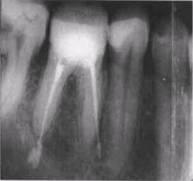 Ошибки и осложнения при эндодонтическом лечении временных зубов