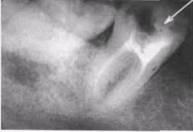 Ошибки и осложнения при эндодонтическом лечении временных зубов