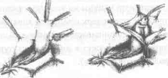 Хирургическая анатомия косых и прямых паховых грыж