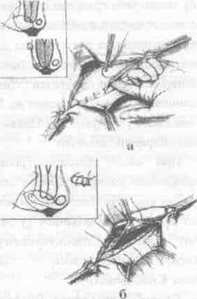 Хирургическая анатомия косых и прямых паховых грыж