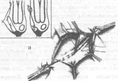 Ущемленная паховая грыжа анатомия