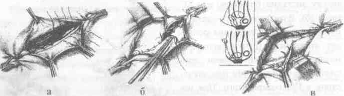Топографическая анатомия паховых грыж