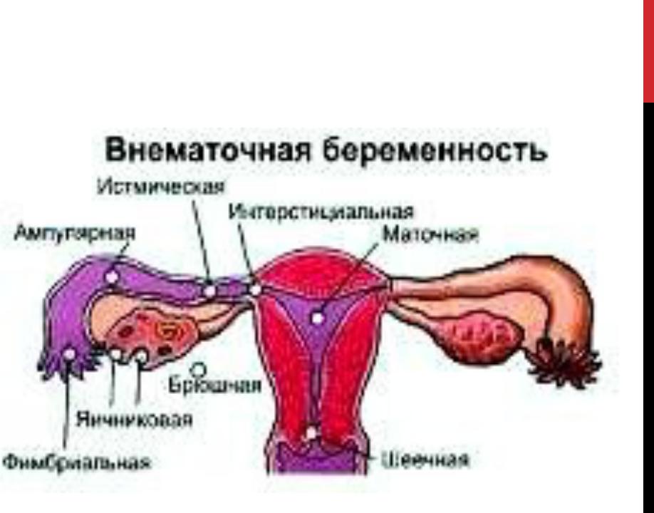 Внематочная беременность. Ампулярная внематочная беременность. Трубная внематочная беременность. Ампулярная Трубная беременность. Внематочная (эктопическая) беременность.