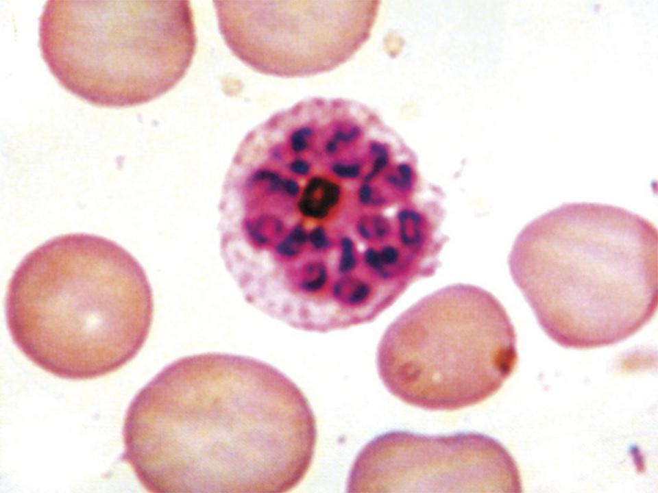 Малярийный плазмодий клетка. Разрушение эритроцитов малярийным плазмодием. Клетки малярии. Малярийный плазмодий под микроскопом. Малярийный плазмодий в микроскопе в эритроцитах.