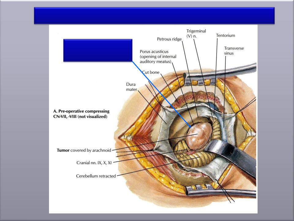 Internal open. Мосто-мозжечковый угол анатомия. Опухоли мосто-мозжечкового угла. Образование мостомозжечкового угла. Мостомозжечковый угол опухоль.