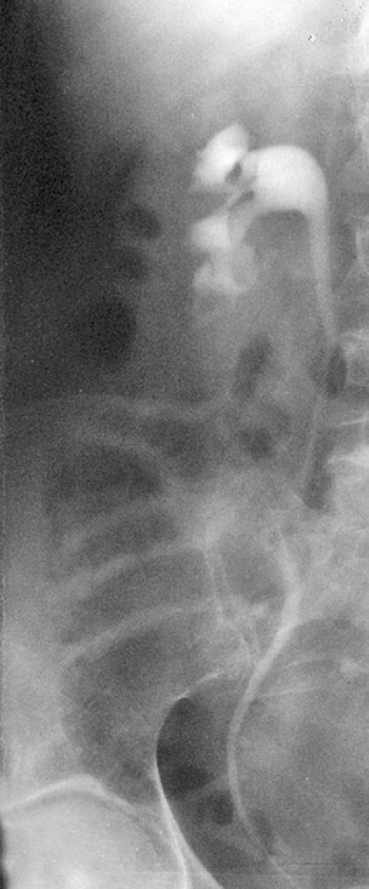 Рентгенонегативные камни почек на кт