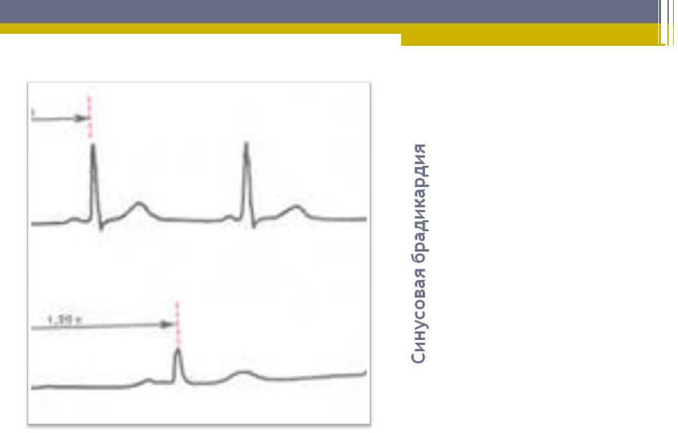 Удлиненное qt на экг. Увеличение интервала RR. Увеличены интервалы r-r.. Интервалы сердечного ритма. R-R интервалы тахикардия.