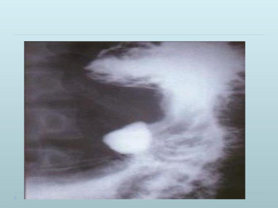 На узи виден желудок. Пенетрирующая язва желудка рентген. Пенетрация язвы желудка рентген. Пенетрирующая язва малой кривизны желудка.