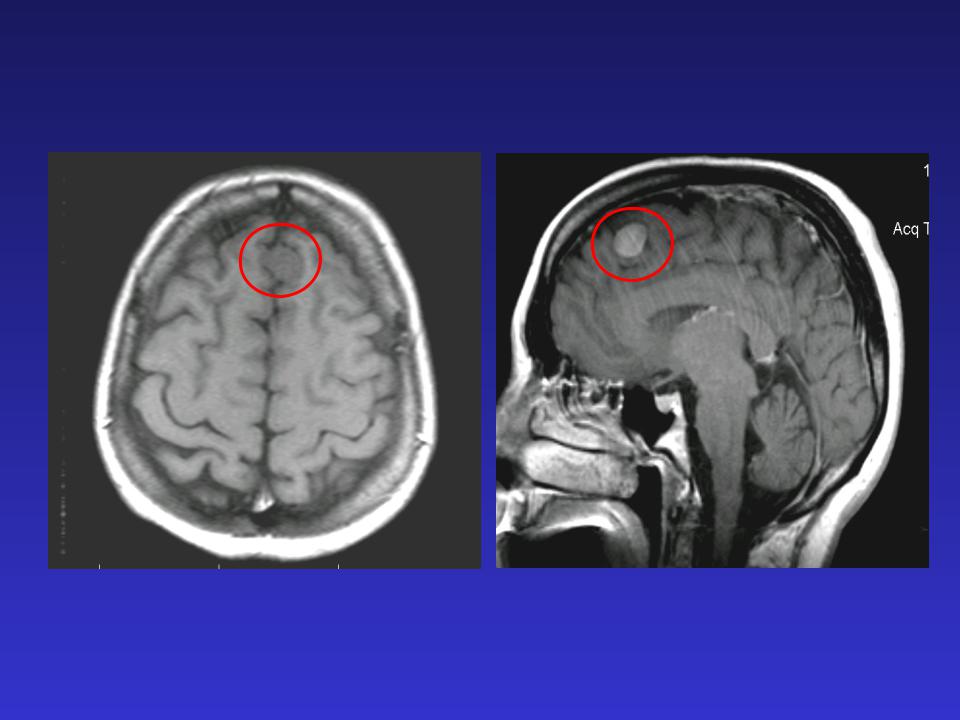 Дистрофические дисциркуляторные изменения мозга. Фалькс менингиома головного. Менингиома передней трети фалькса. МР картина объемного образования. Средней трети фалькса.