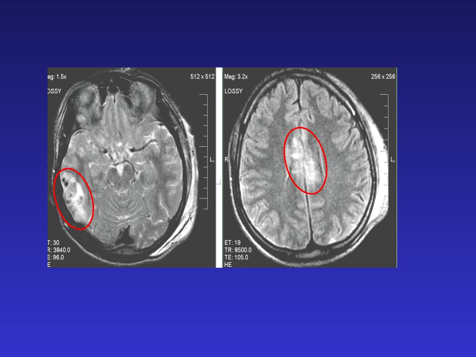 Единичный очаг в левой лобной доле. Мозолистое тело анатомия мрт. Субдуральная гематома ГМ мрт. Эпилепсия мрт височных долей. Очаговые повреждения головного мозга.