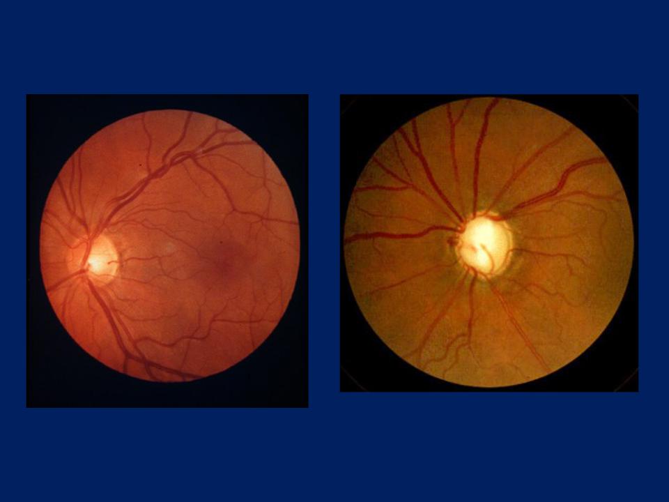 Нейропатия глаза. Атрофия зрительного нерва Лебера. Атрофия зрительного нерва Лебера генетика. Наследственная оптическая нейропатия Лебера. Наследственная нейропатия зрительного нерва Лебера.