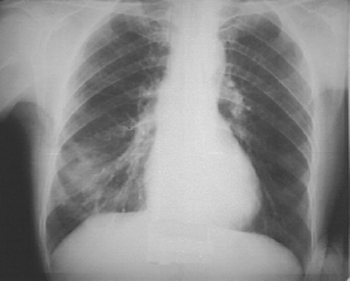 Абсцесс лёгкого (абсцедирующая пневмония)
