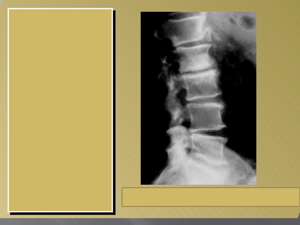 Спондилез l5. Остеофиты на рентгене шейного отдела. Остеофиты на рентгене позвоночника. Остеофиты шейного отдела позвоночника рентген. Спондилёз шейного отдела позвоночника что это такое.