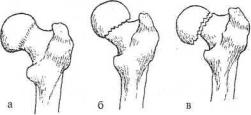 Вколоченный перелом шейки бедра. Вколоченный перелом шейки бедра рисунок. Шеечно-диафизарный угол плечевой кости. Поперечный перелом бедра схема без смещения. Вколоченный перелом собак.