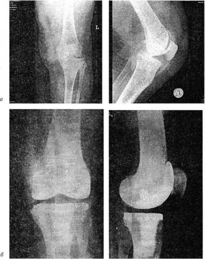 Патогенез деформирующего артроза коленного сустава
