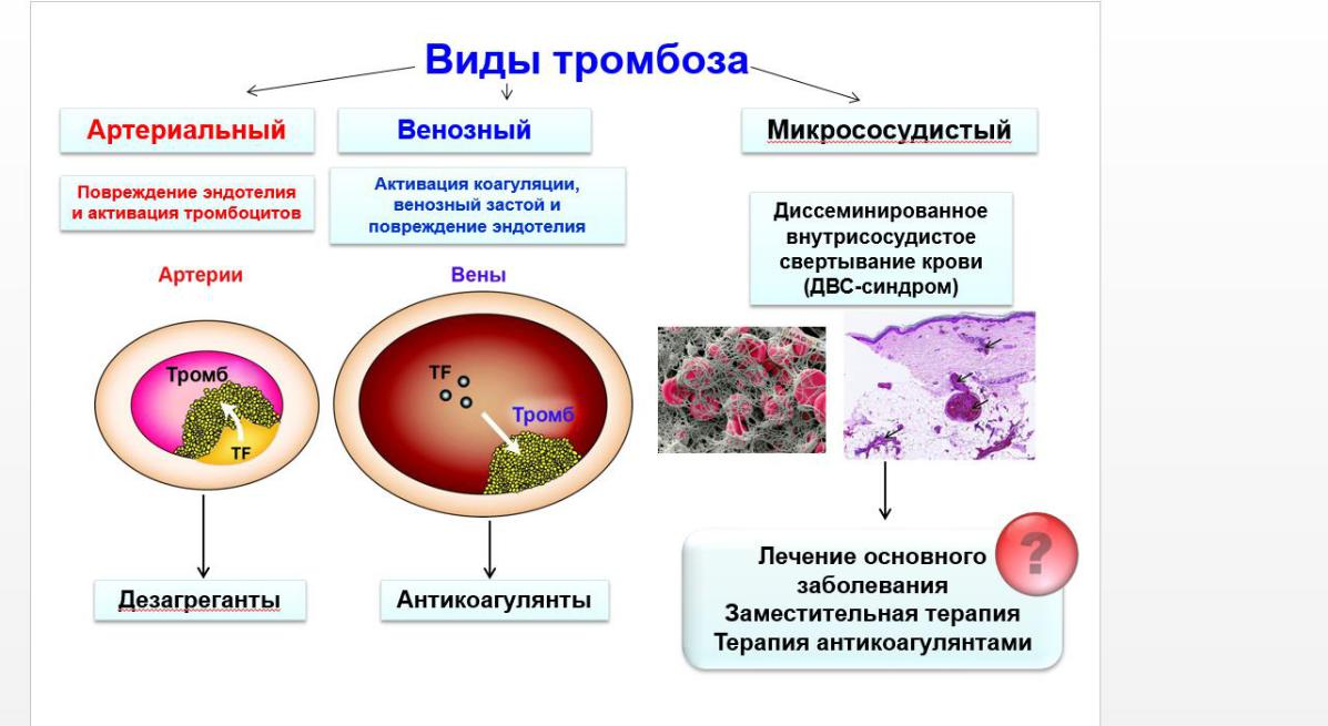 Тромбоз определение. Виды тромбоза. Патогенез формирования тромба. Тромбоз классификация патофизиология. Тромбоз патогенез схема.